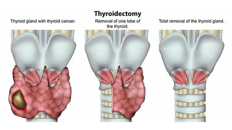 thyroidectomy