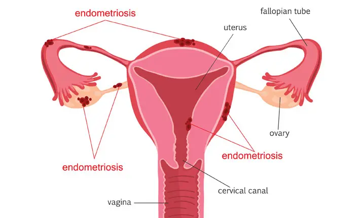 Endometriosis a growing concern