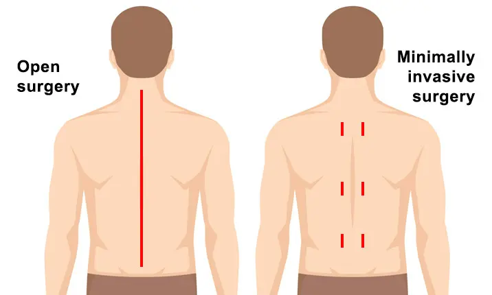 open spine surgery