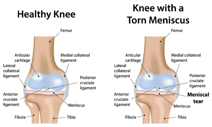 Medial collateral ligament injury: MedlinePlus Medical Encyclopedia Image