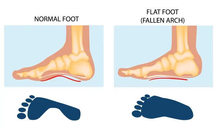 Flat foot hot sale problem solution