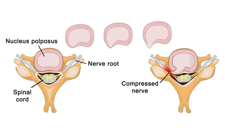 What Happens If A Bulging Disc Goes Untreated? - The Spine & Rehab