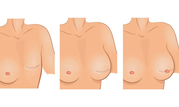 Breast reconstruction surgery