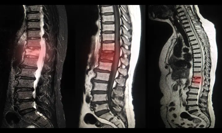 Degenerative spine diagnosis scan