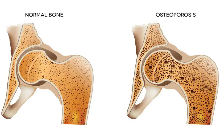 osteoporosis fracture sites