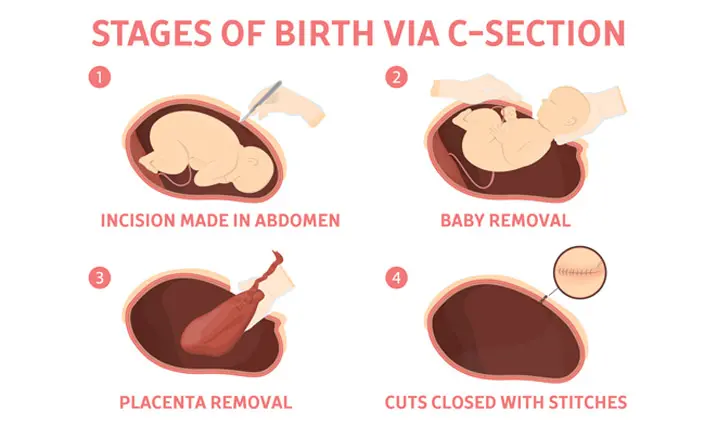 Childbirth delivery caesarean section
