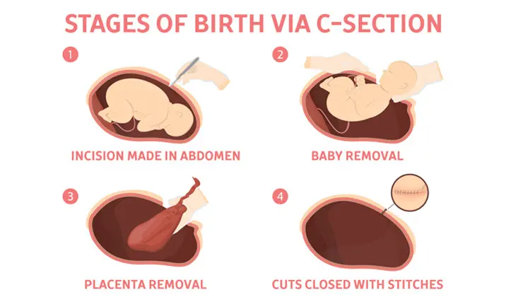 Is a C-section birth easier to recover from than a natural birth