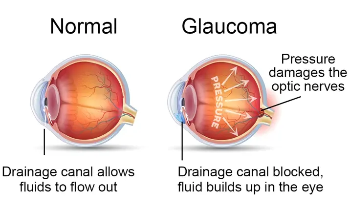 Glaucoma due to fluid build-up