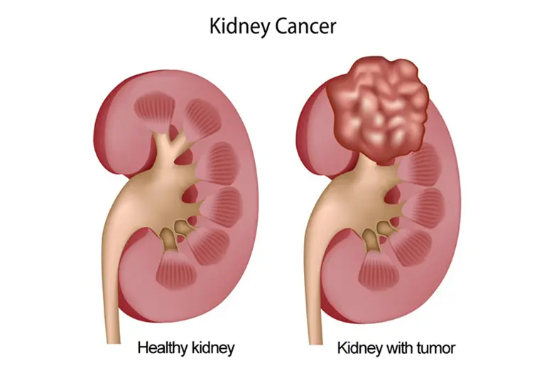 kidney-sparing