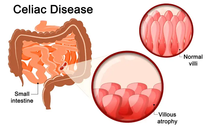 Gluten Intolerance (Sensitivity): Signs and Symptoms