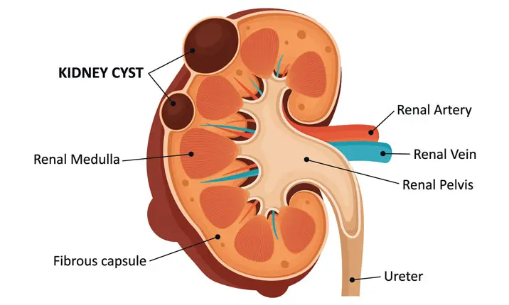 What are kidney cysts?
