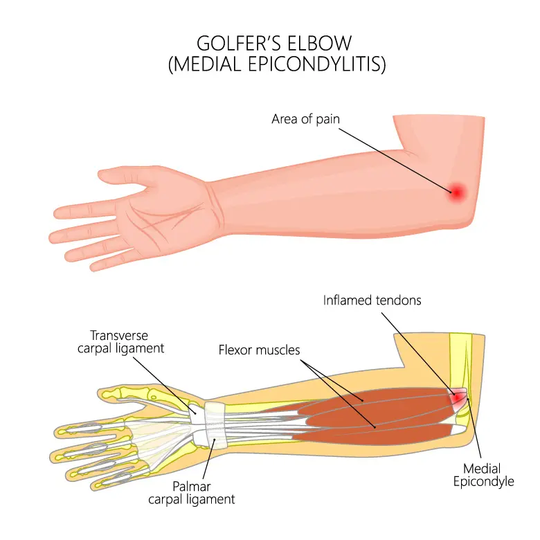 高尔夫球肘是指肘部内侧疼痛，其中一条连接前臂肌肉与肘关节的肌腱发生肿胀