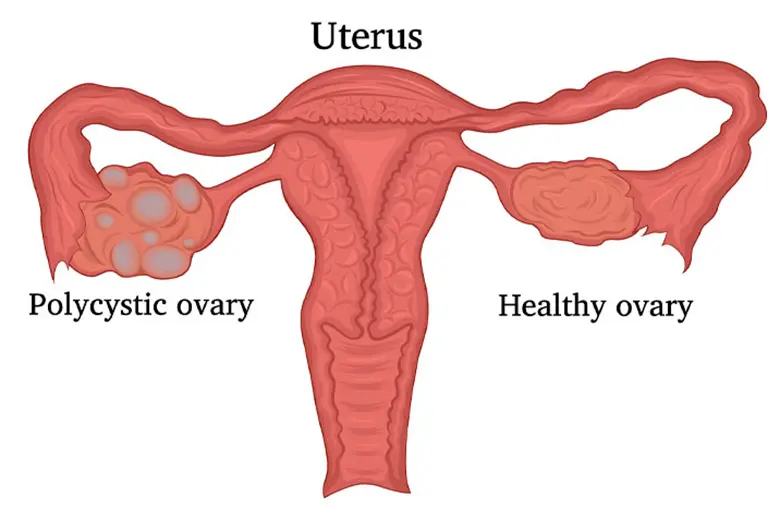 normal vs polycystic ovaries ultrasound