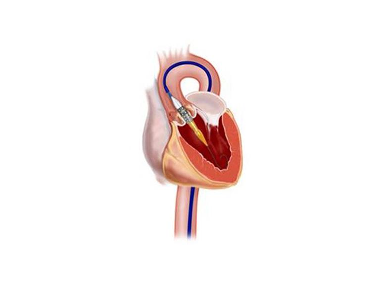 Transcatheter Aortic Valve Implantation (TAVI) | Parkway East Hospital