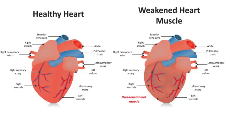 Weak heart muscle cardiomyopathy