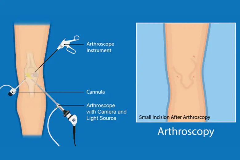 arthroscopy-knee
