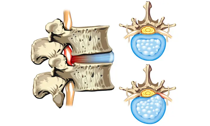 Prolapsed Disc - Causes, Symptoms, & Treatment