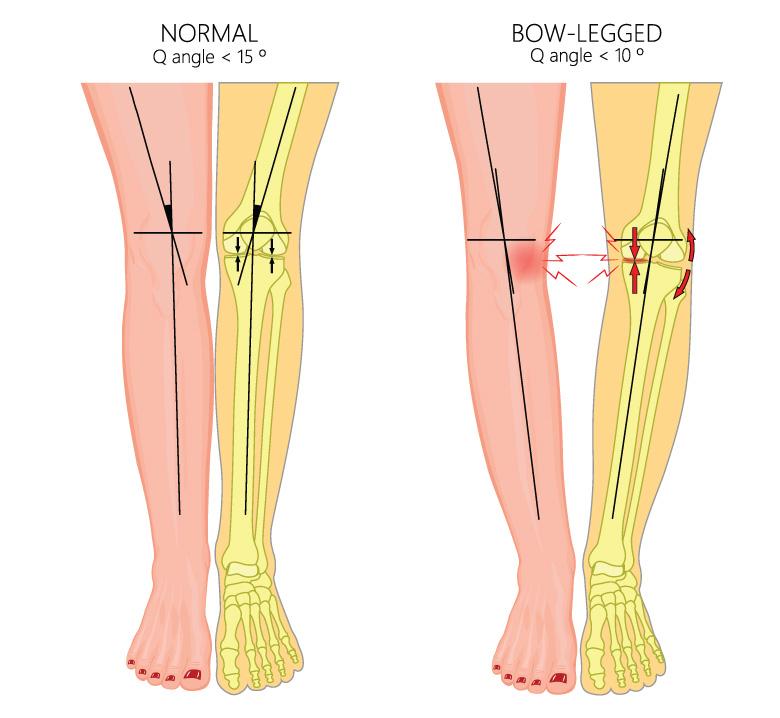 Bow legs is a condition where the legs curve outward at the knees.