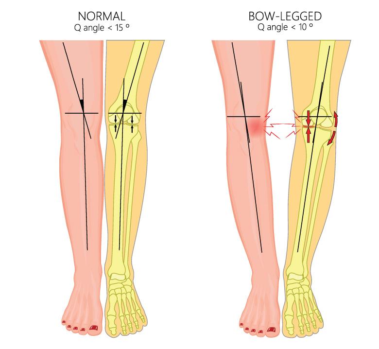 Bow Legged Correction Surgery