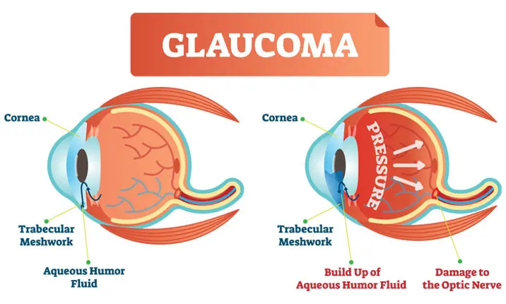 What is glaucoma?