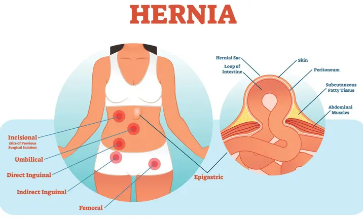 Hernia types