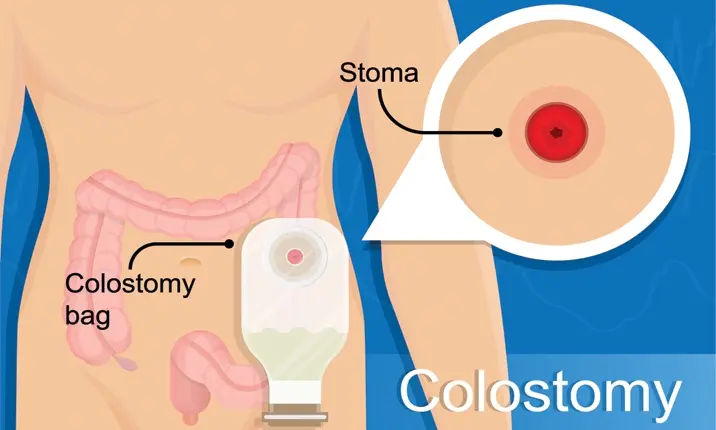 What is a stoma?
