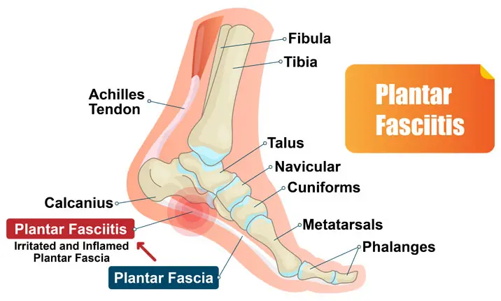 Pain in heel hot sale and ankle area