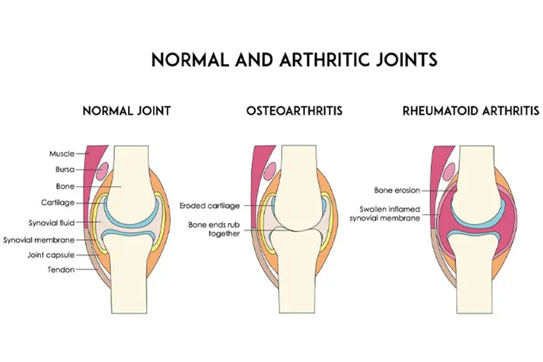 Osteoarthritis and rheumatoid arthritis both cause pain and swelling in the joints.