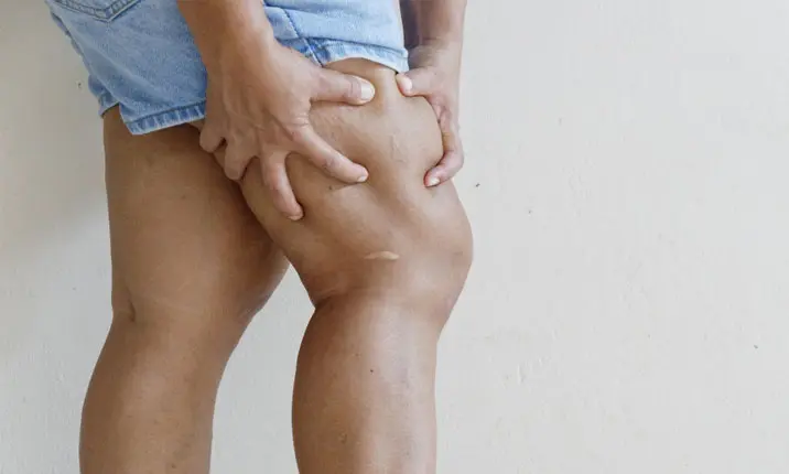 Deep Vein Thrombosis, Explained