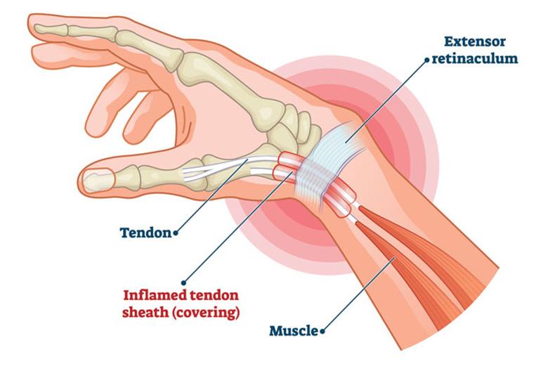 Tenosinovitis De Quervain adalah suatu kondisi menyakitkan yang memengaruhi tendon pergelangan tangan.