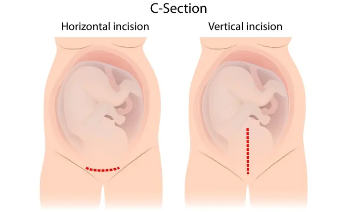 Exploring Birth Options: Normal Delivery vs. C-Section