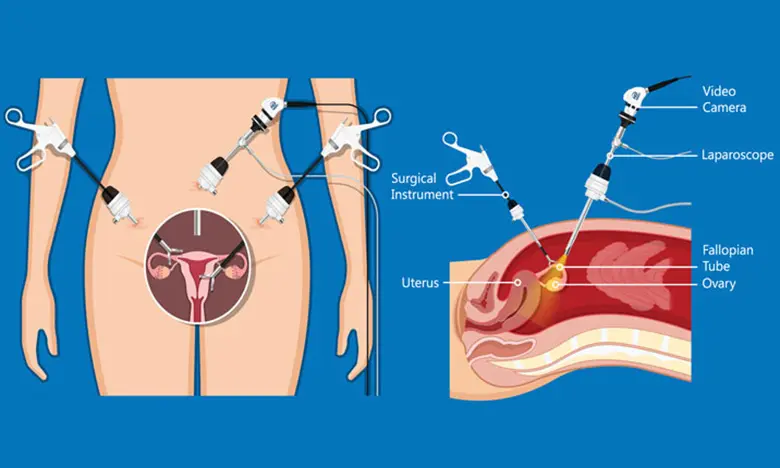 mis-cystectomy-performed-how