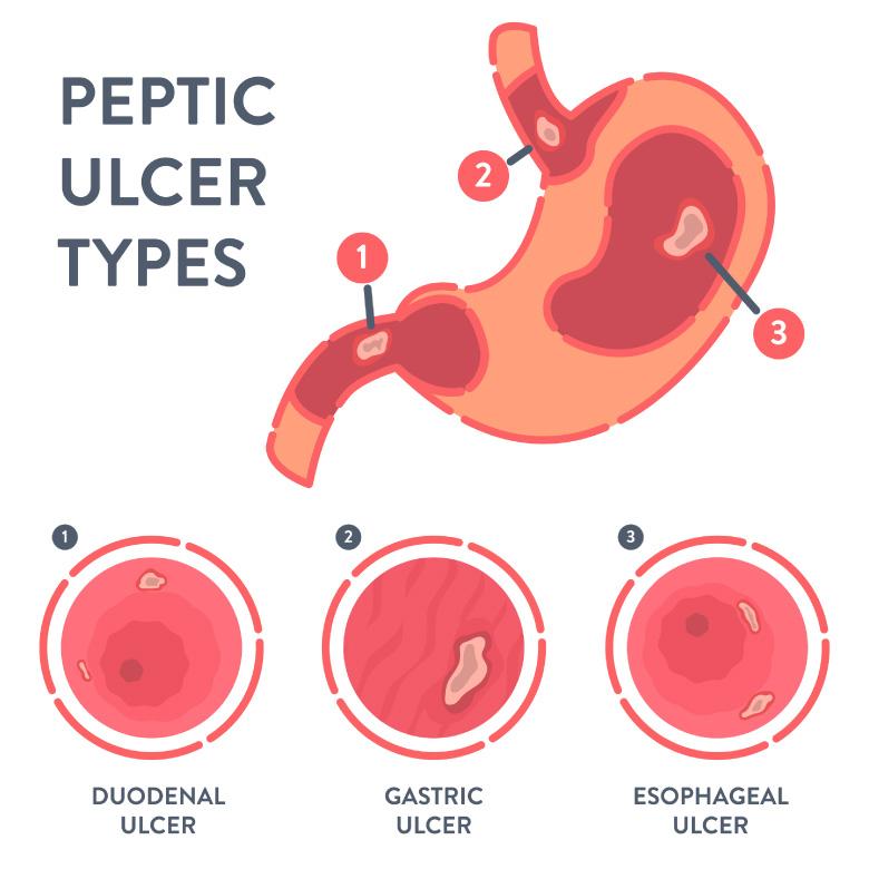 stomach ulcer pain location