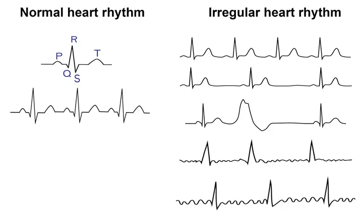 Heart Rhythms: What's Normal Versus Cause for Concern?