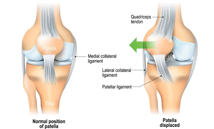 Medial collateral ligament injury: MedlinePlus Medical Encyclopedia Image