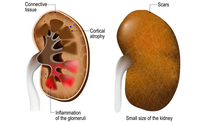 Kidney failure inflammation of glomerulus
