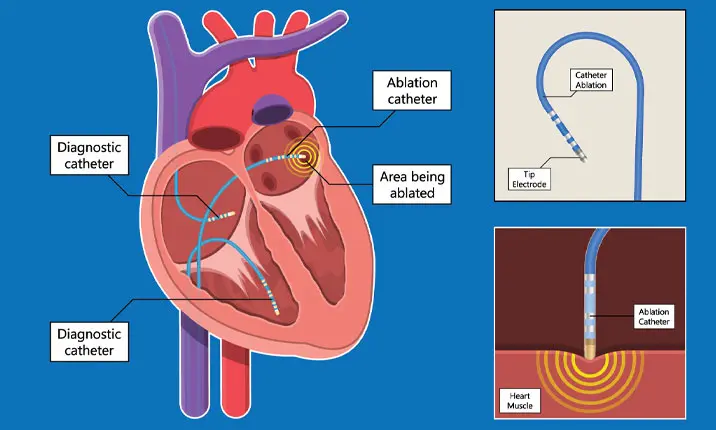Cardiac ablation procedure