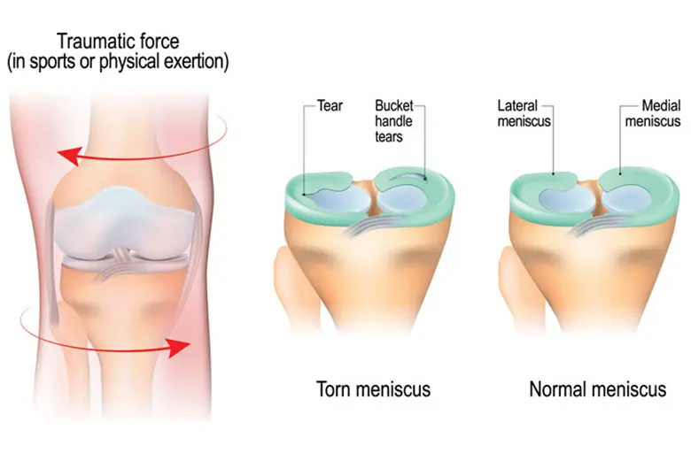 如果在运动中强行扭转膝关节而足部保持原地不动，就会发生半月板撕裂。