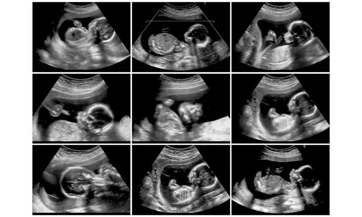 Detailed foetal anomaly scan