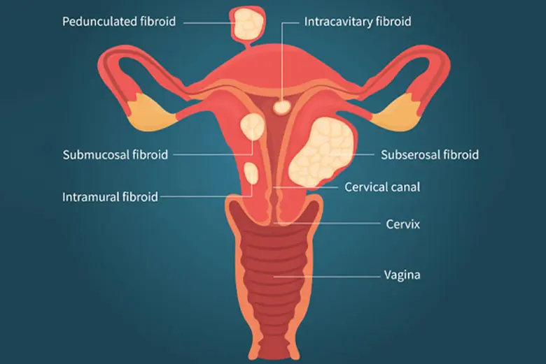 Different types of uterine fibroids, which causes different symptoms.