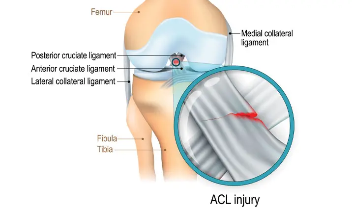 Anterior cruciate ligament (ACL) injury: MedlinePlus Medical Encyclopedia