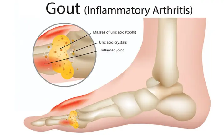 Should You Consider Surgery for Gout?