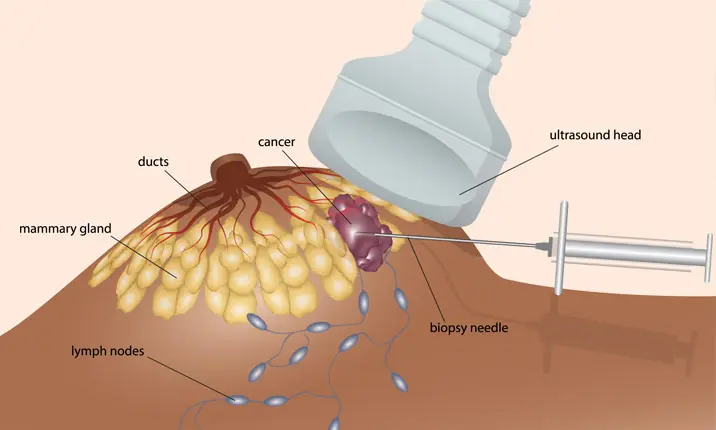 Women's Wellness: What do you know about having a breast biopsy