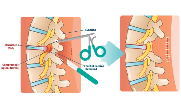 Herniated disk: MedlinePlus Medical Encyclopedia