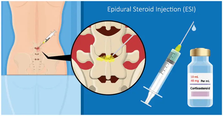 corticosteroids injections