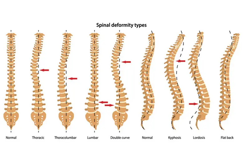 spine-deformities-corrective-osteotomy