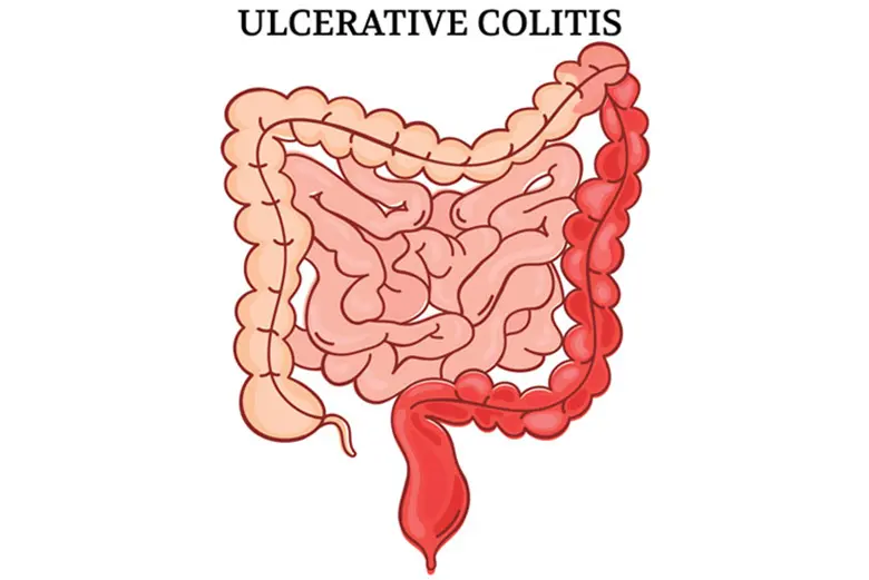 Patients with ulcerative colitis have chronic inflammation and ulcers in their colon and rectum.