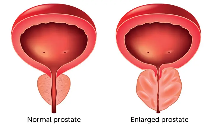 Enlarged prostate symptoms