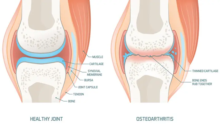 Knee replacement surgery - Arthritis