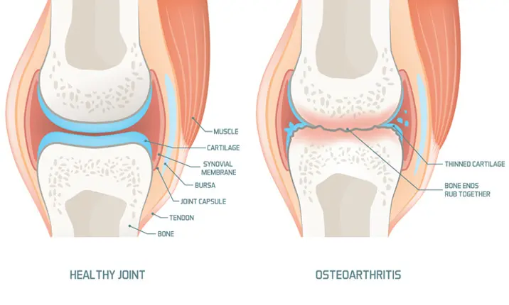 Knee deals cap surgery